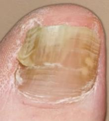 snaggable uneven nail